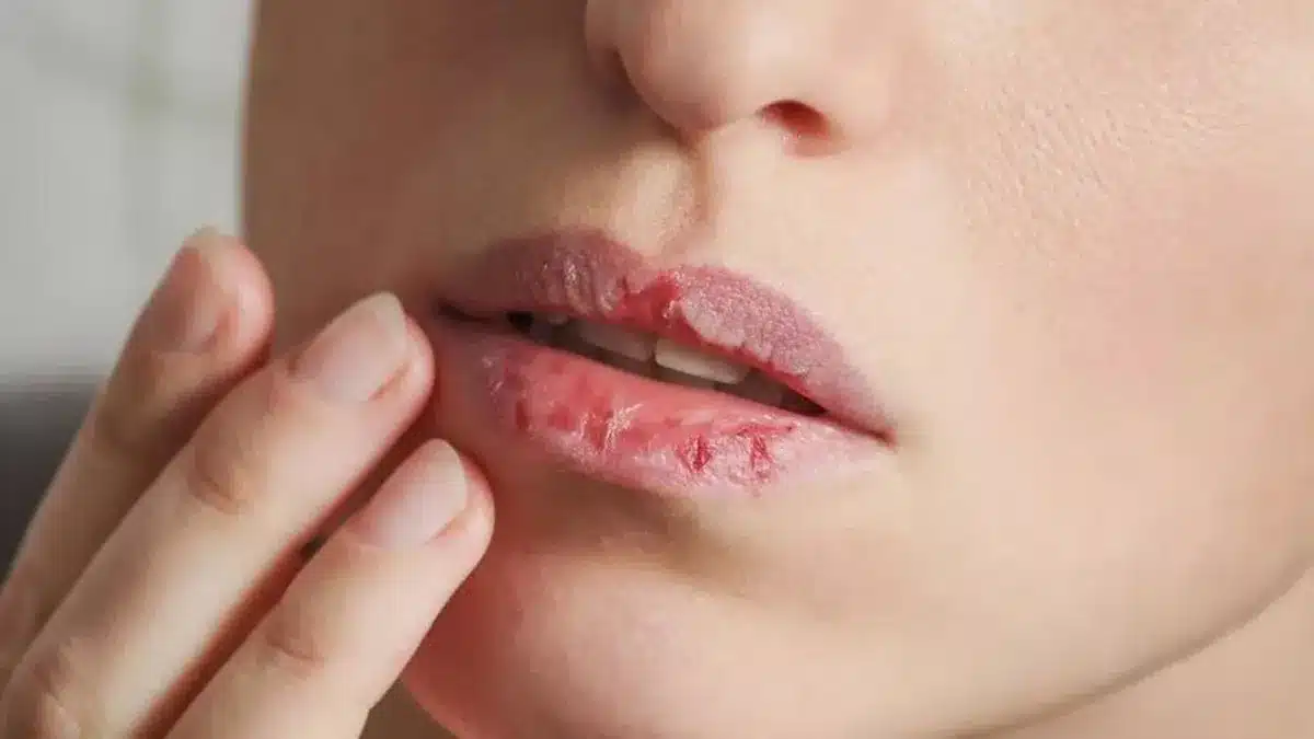 Bờ môi khô và nứt nẻ
